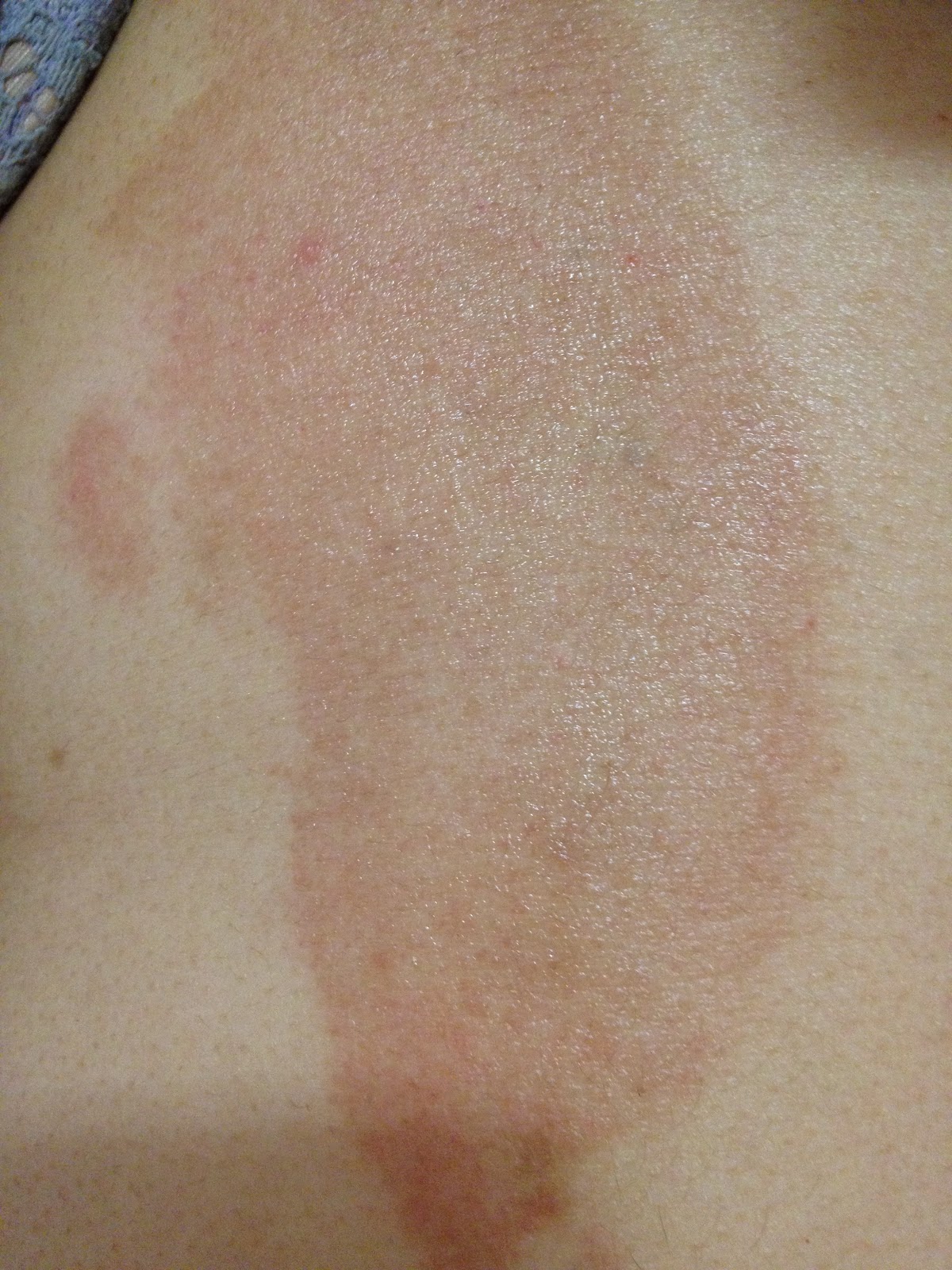 Palmer's cocoa butter. See it used on me! Do not read post if sensitive